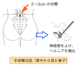 手術模式図
