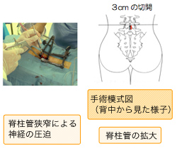 手術模式図(背中から見た様子)