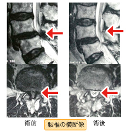 腰椎の横断像